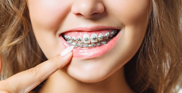 Close-up of a patient smiling with metal dental braces during orthodontic treatment