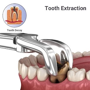 Medical illustration showing a tooth extraction procedure for a decayed tooth